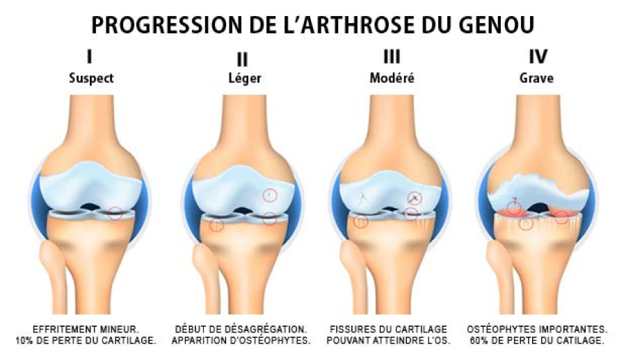 progression-de-l_arthrose-du-genou